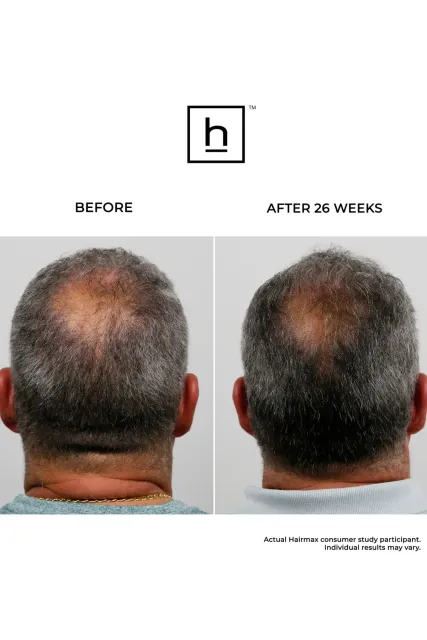 HairMax Ultima 9 LaserComb, image 2
